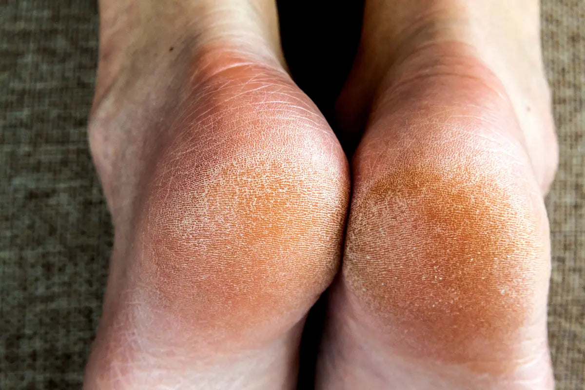 Why You Need to Hydrate your Feet