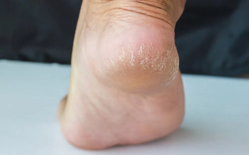 FEETS Foot Peel Mask treatment