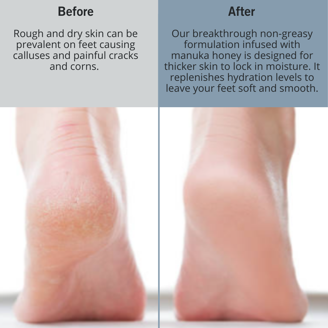 Callus My Feet So Dry Cracked Repairing Foot And Heel Cream – FEETS