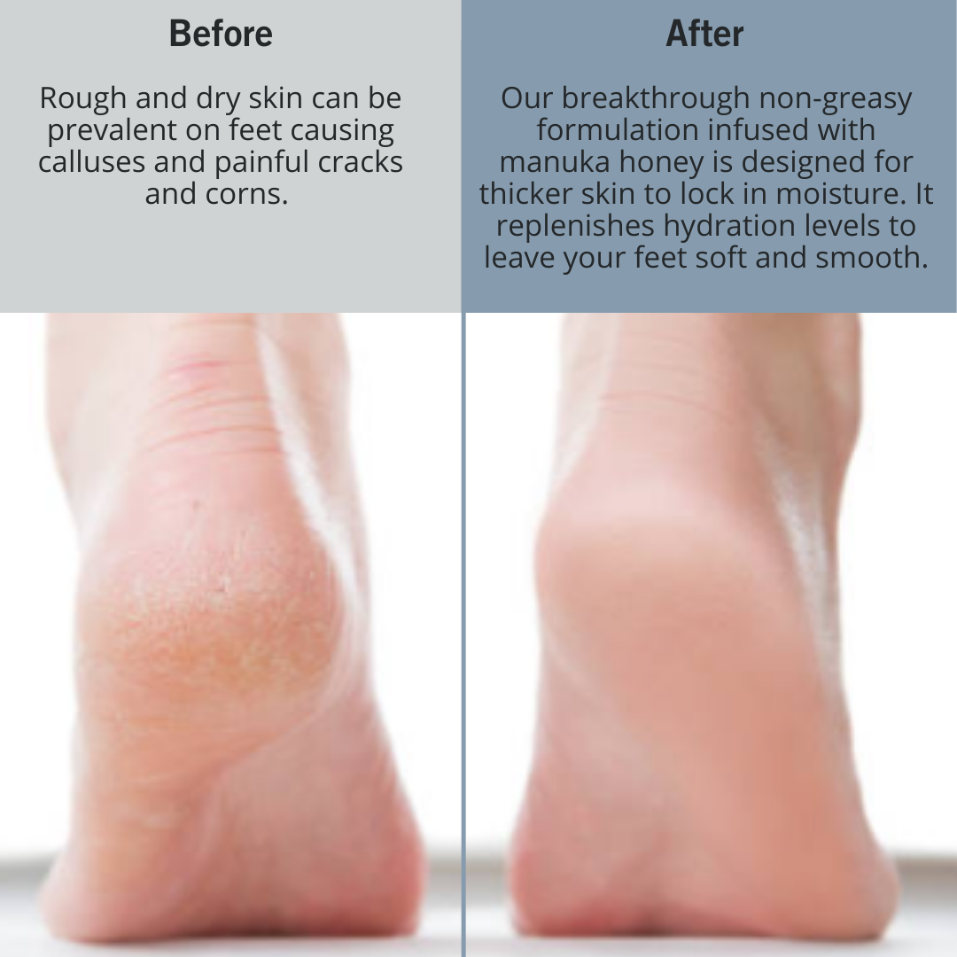 Before and after dry crack heels vs soft heels